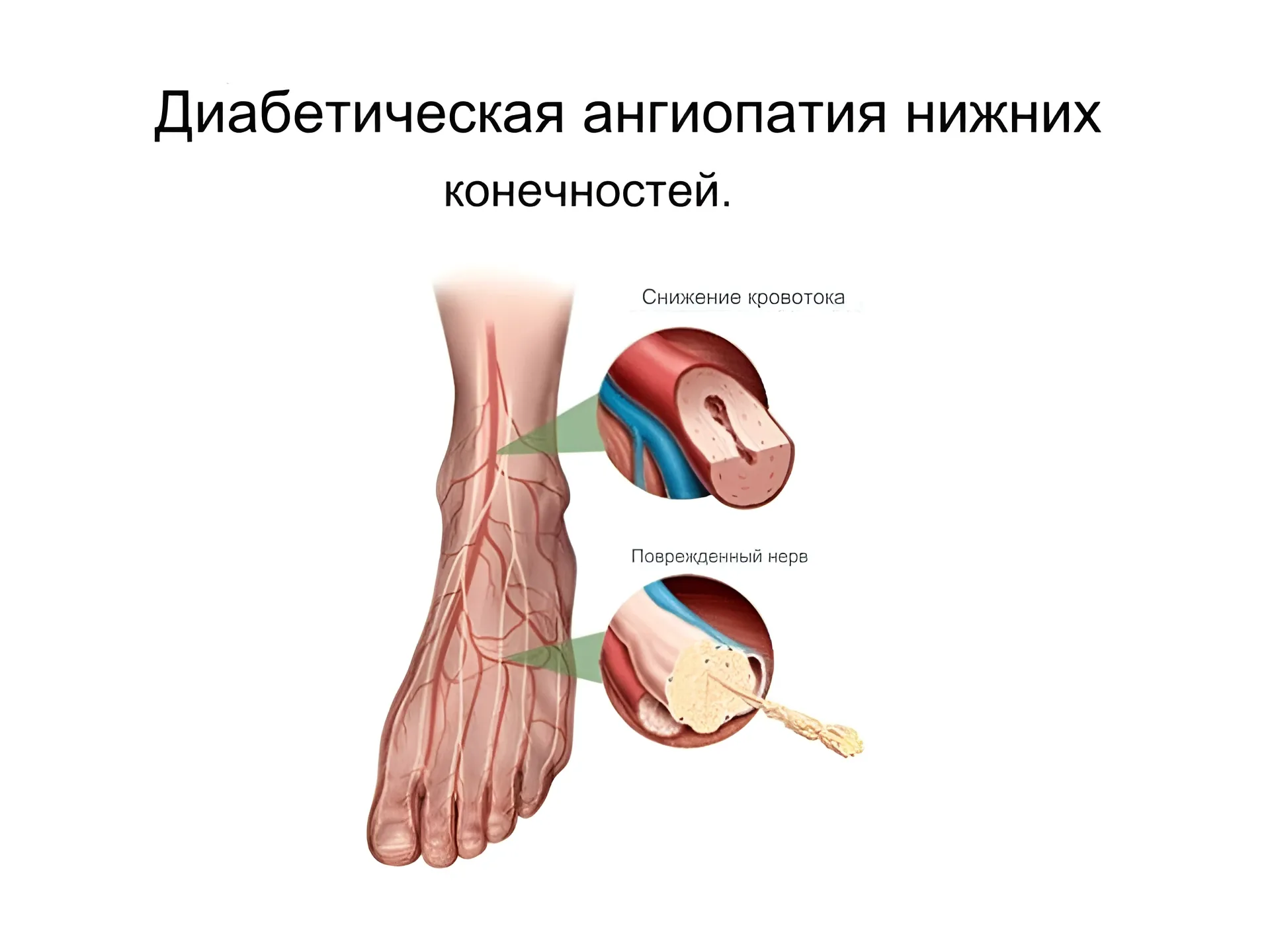 Диабетическая ангиопатия Диабетическая ангиопатия