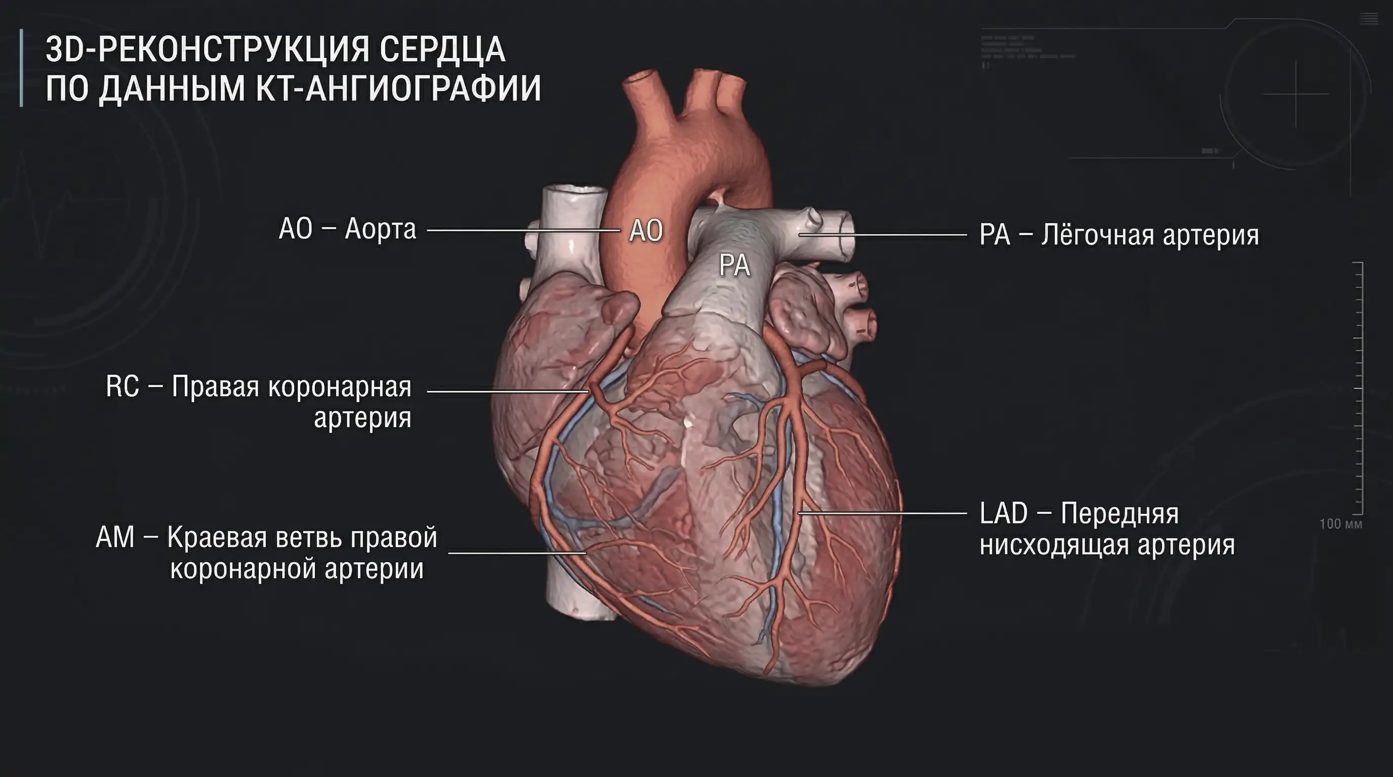 3D-rekonsrukciya-KT 3D-реконструкция КТ сердца