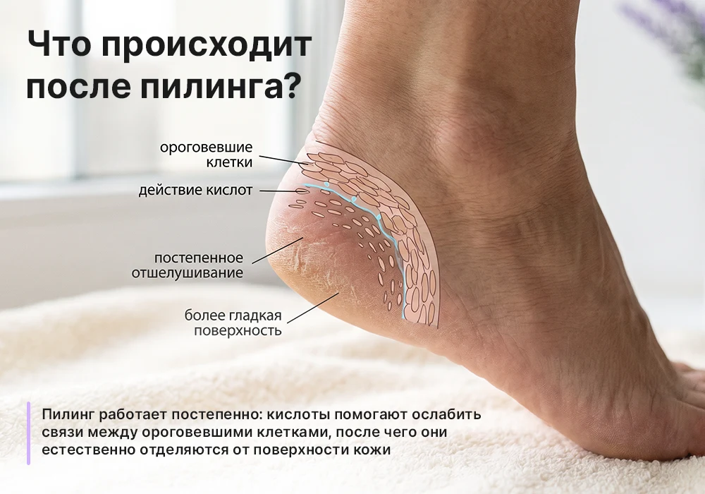 Пилинг-носочки для стоп: как работают кислоты