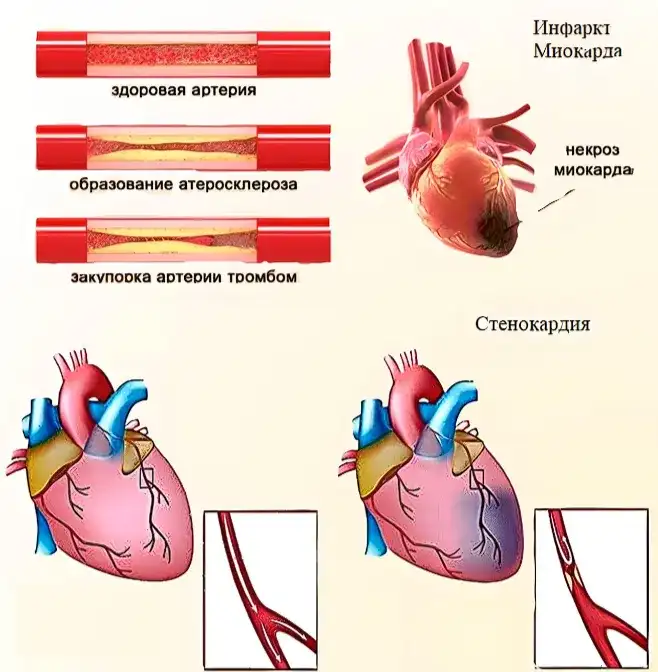 Болезни сердца 2 Болезни сердца 2