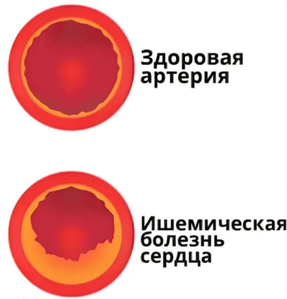 Ишемическая болезнь сердца Ишемическая болезнь сердца