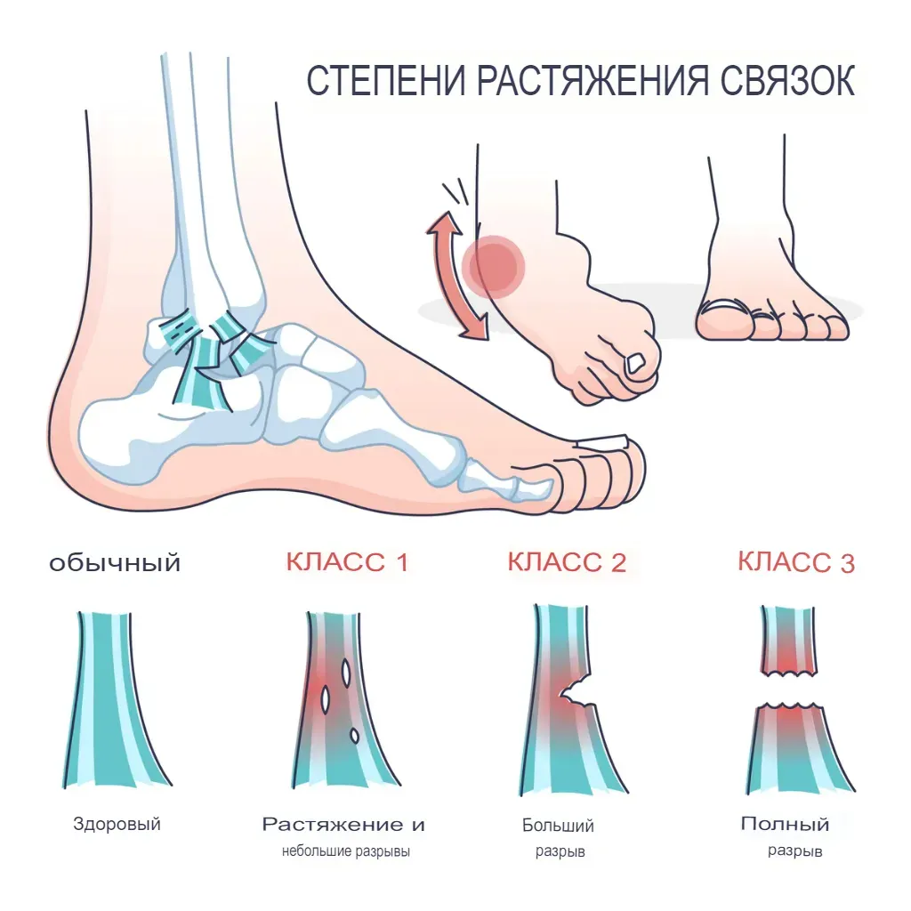 Степени растяжения связок