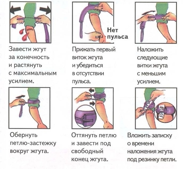 инструкция как накладывать жгут эсмарха