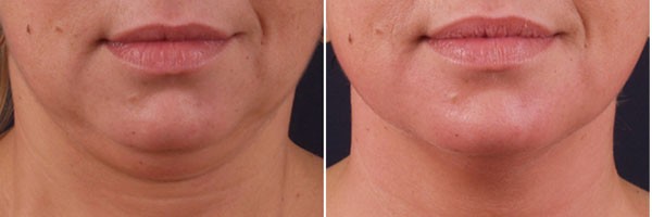 Triada PBSerum | Ферментный комплекс Триада