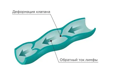 болезни лимфатической системы