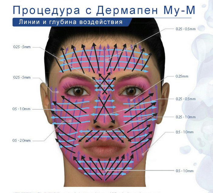 dermapen-face.jpg