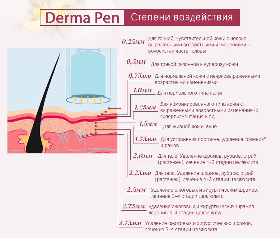 dermapen-stepen.png