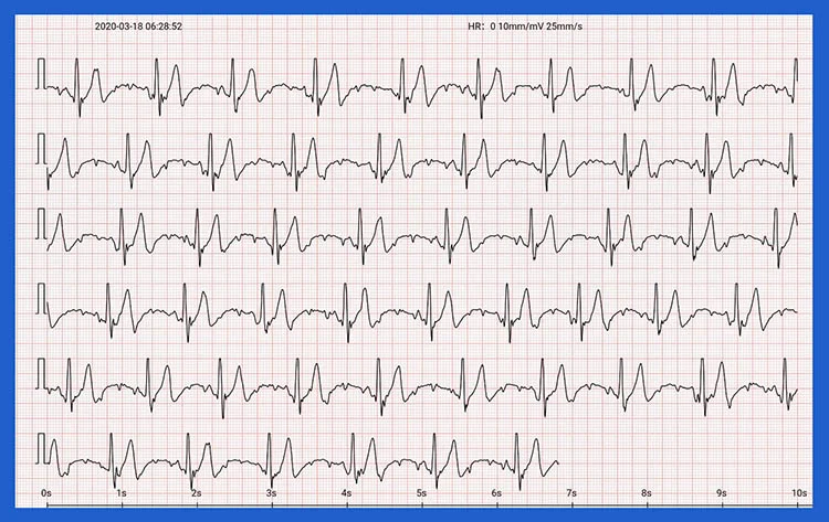 EKG-Biomer-bt-68