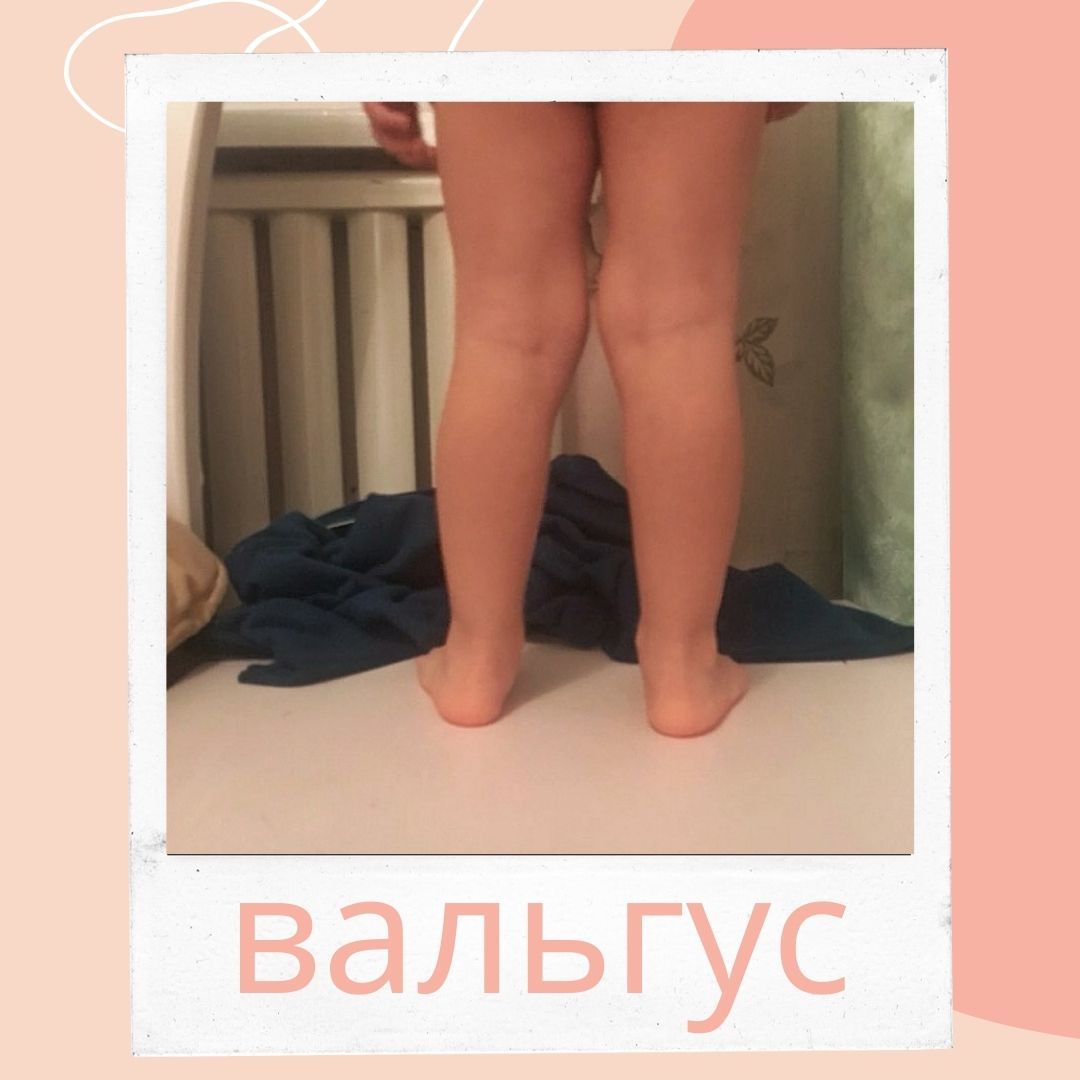 Приводить ребенка к ортопеду или нет?
