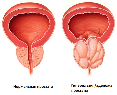 Аденома простаты
