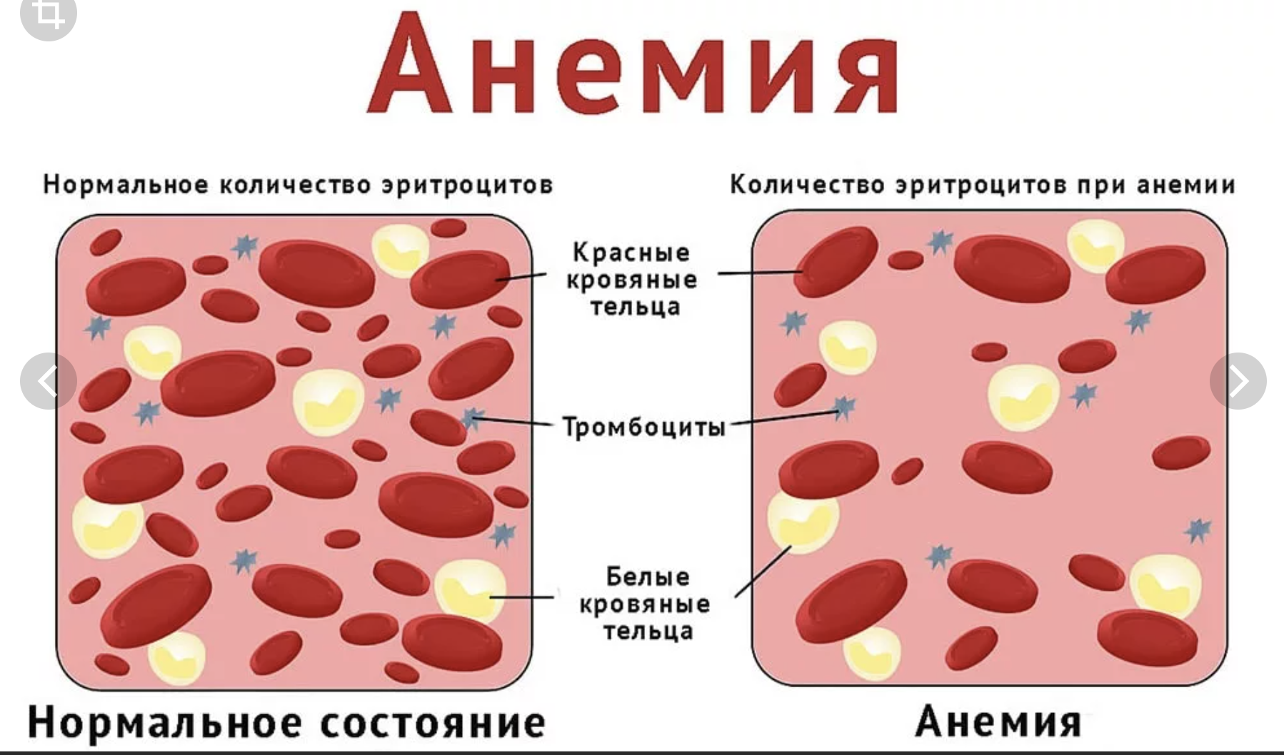 Анемия