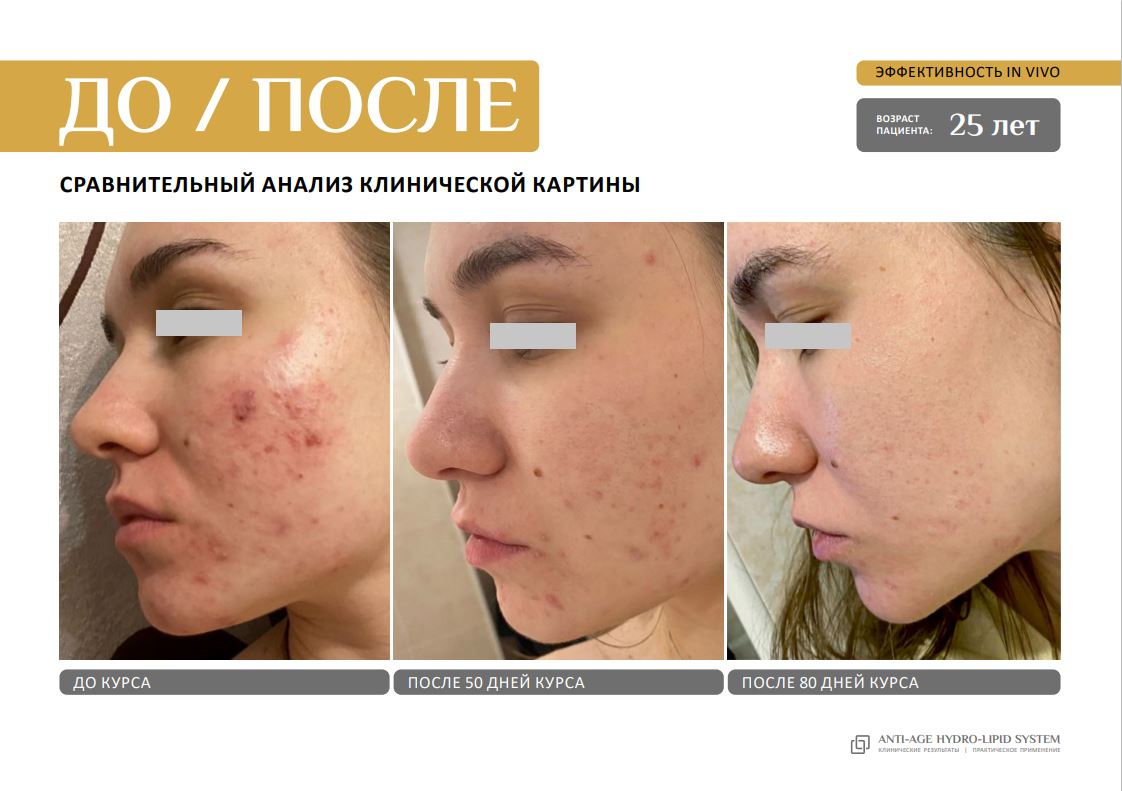 EVIPRO ANTI-AGE HYDRO-LIPID SYSTEM Омолаживающий комплекс (сыворотка 30мл, крем 30мл)