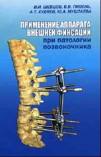 Позвоночник Применение аппарата внешней фиксации при патологии позвоночника Применение_аппарата_внешней_фиксации_при_патологии_позвоночника.jpg