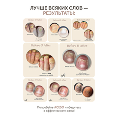 Famous Names, ACESO Двухфазный набор для лечения ногтей + дебридер