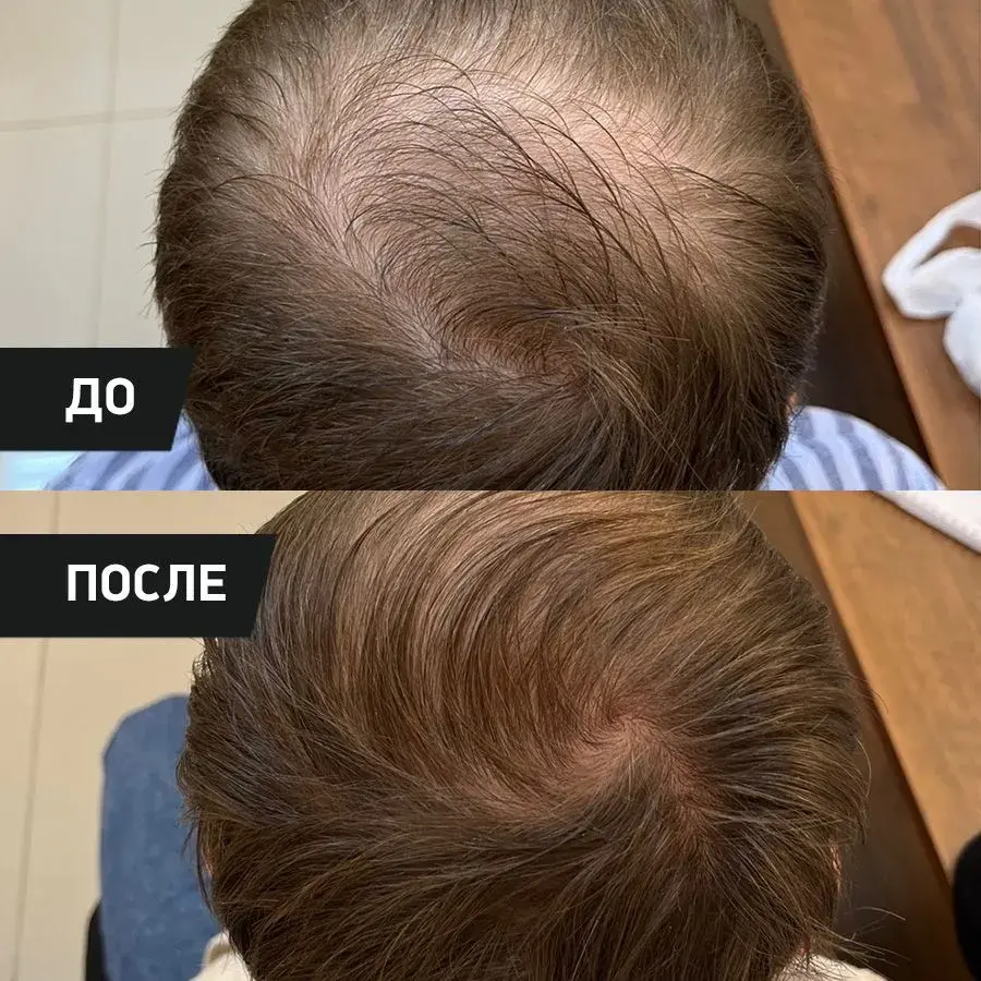 PERFOTESORO кислородная сыворотка для активного роста волос