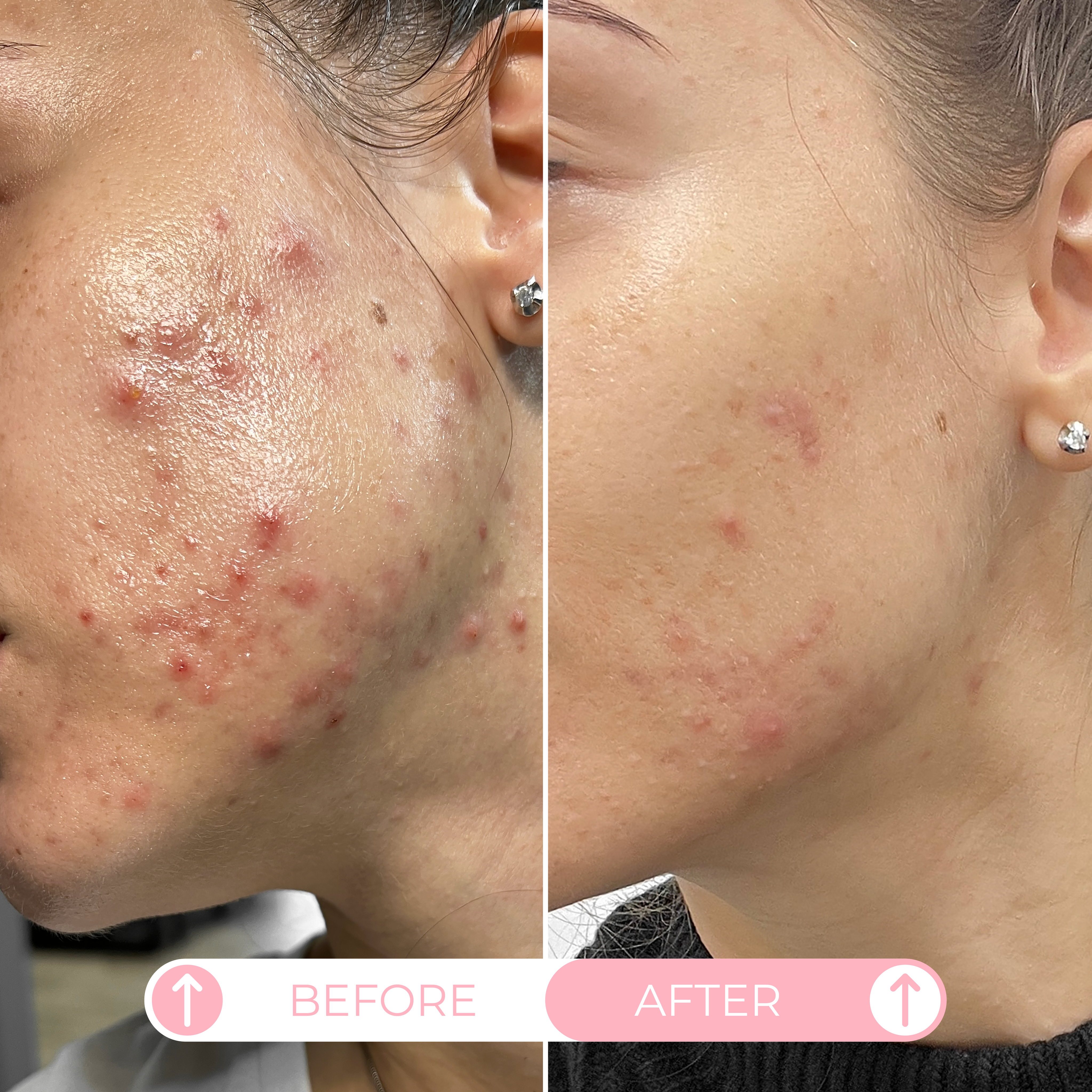 APPEEX POST TREATMENT CREAM 30 ml Пост-процедурный регенерирующий крем