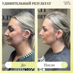 LemonBottle Ampule Solution | Липолитик непрямой