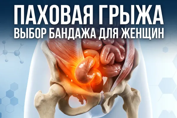 Паховая грыжа у женщин: как распознать и какой бандаж поможет до операции.