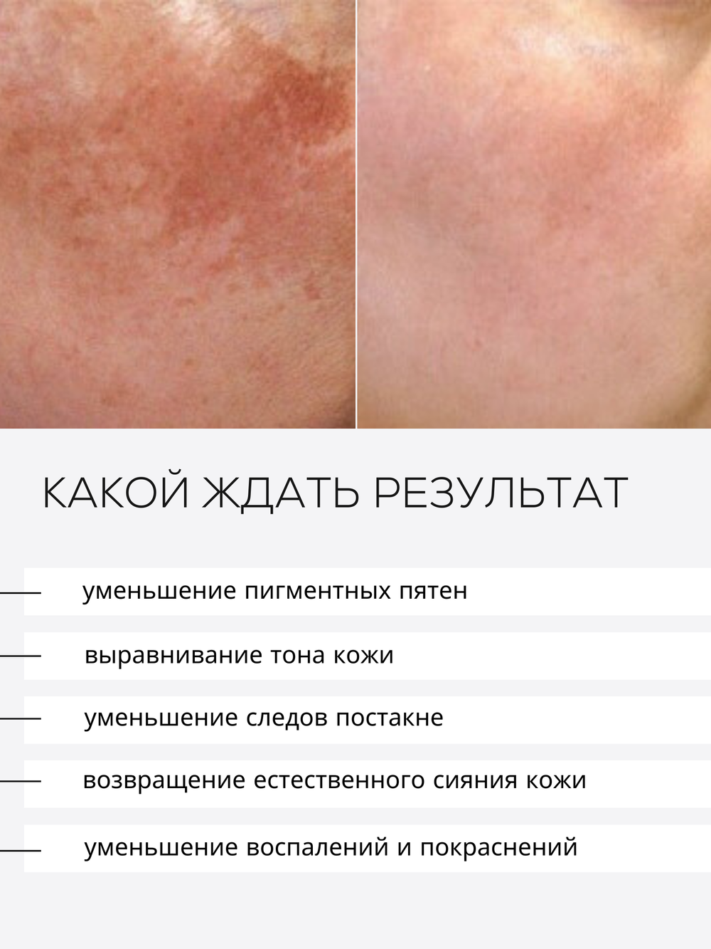 СЫВОРОТКА ОТ ГИПЕРПИГМЕНТАЦИИ