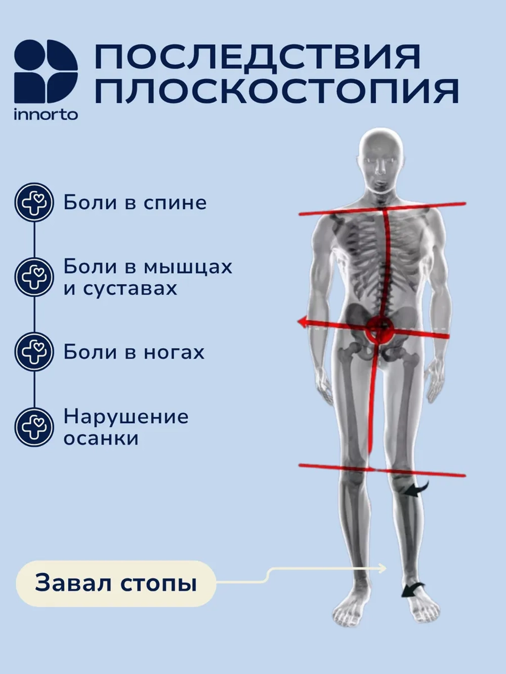 Супинаторы ортопедические от плоскостопия