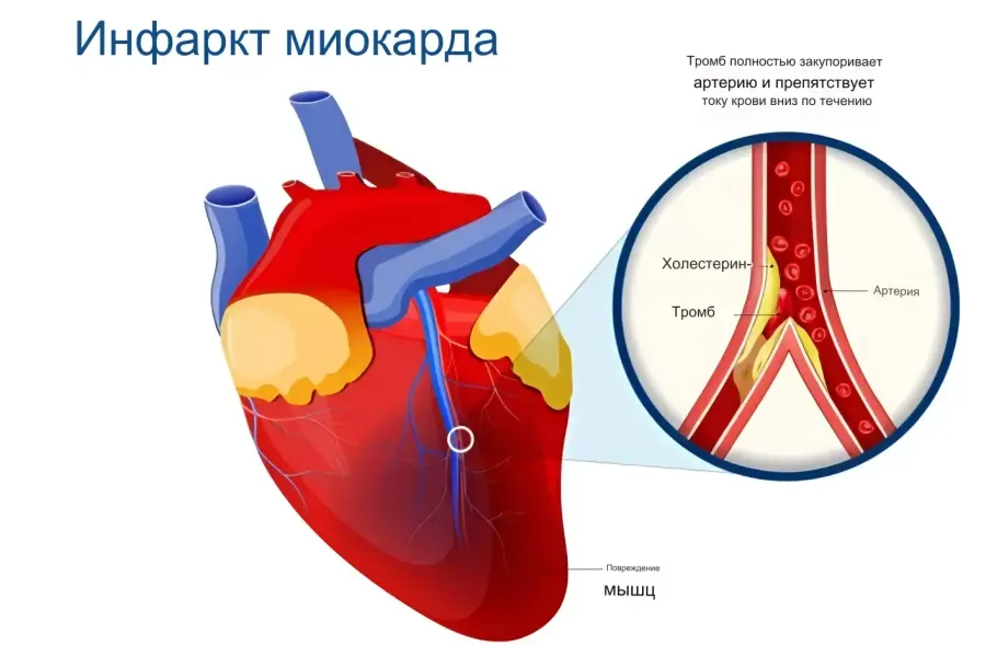 Инфаркт миокарда Инфаркт миокарда