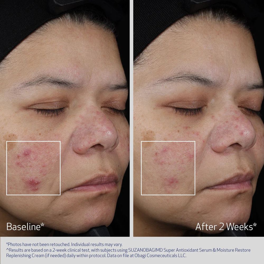 Obagi Medical Суперинтенсивная антиоксидантная сыворотка SuzanObagiMD Super Antioxidant Serum Potent Antioxidant Blend 30 гр