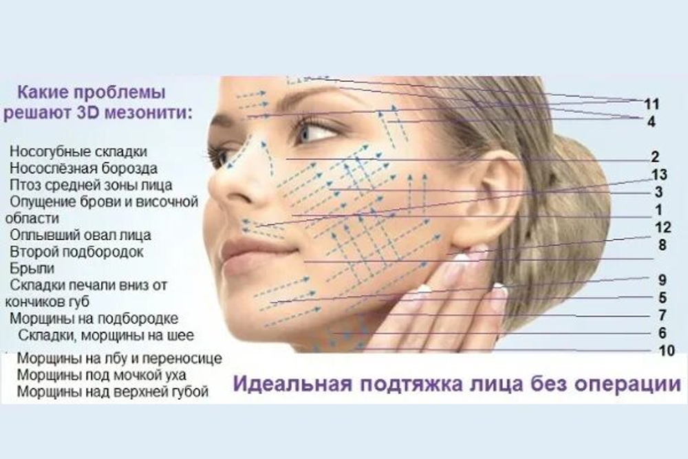 Армирование мезонитями по зонам лица