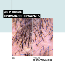 L'Oreal Скальп Анти-Дандрифф шампунь 300мл