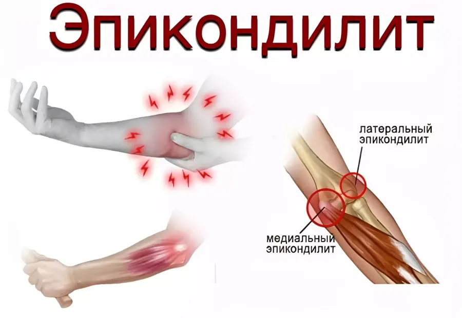 Что такое эпикондилит локтя? Что такое эпикондилит локтя?