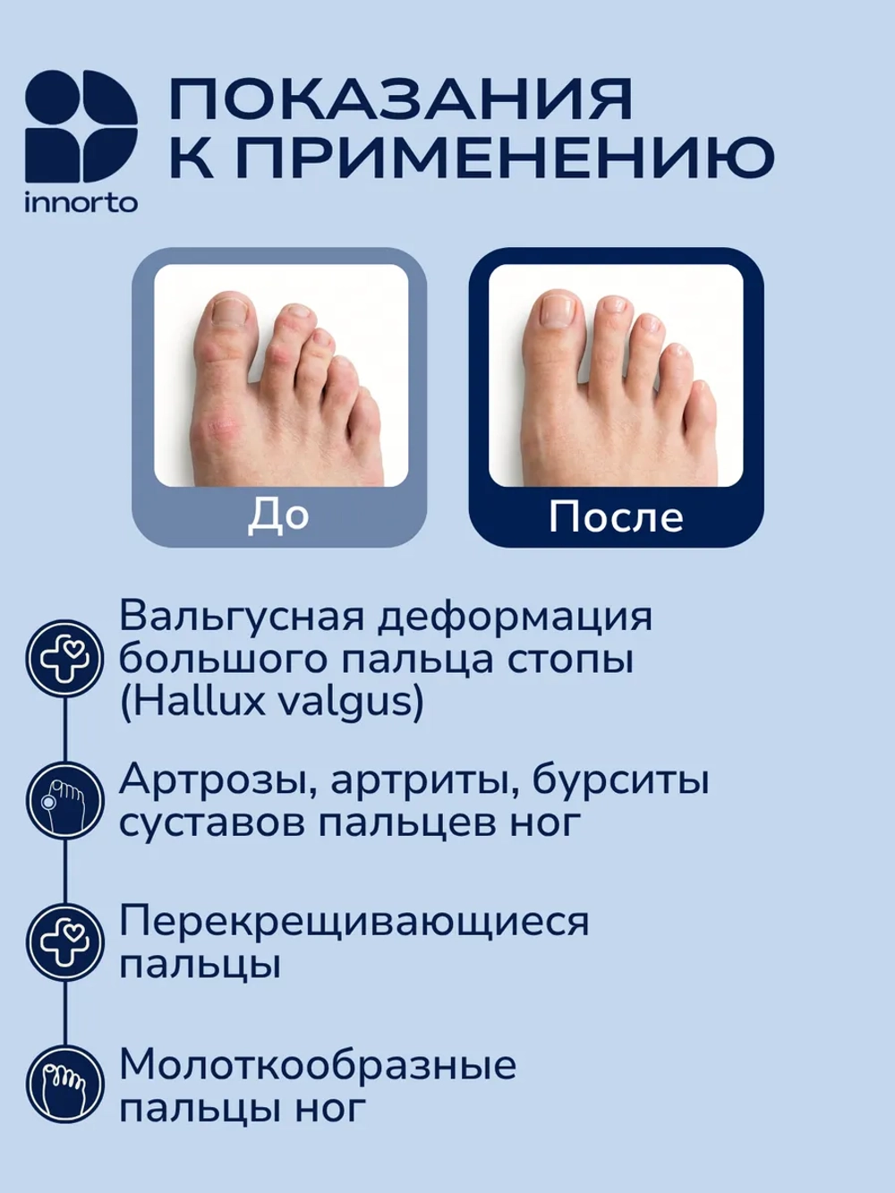 Разделитель пальцев ног ортопедический