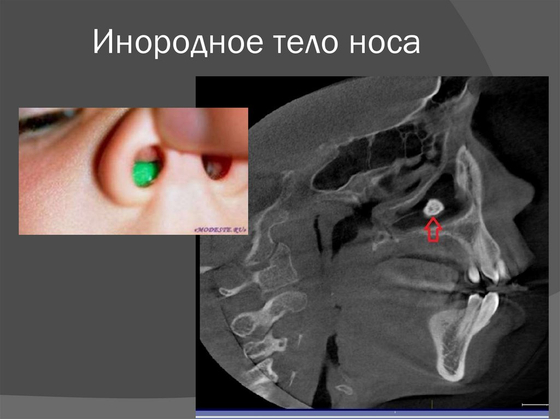 Модель носа (носоглотки) в разрезе