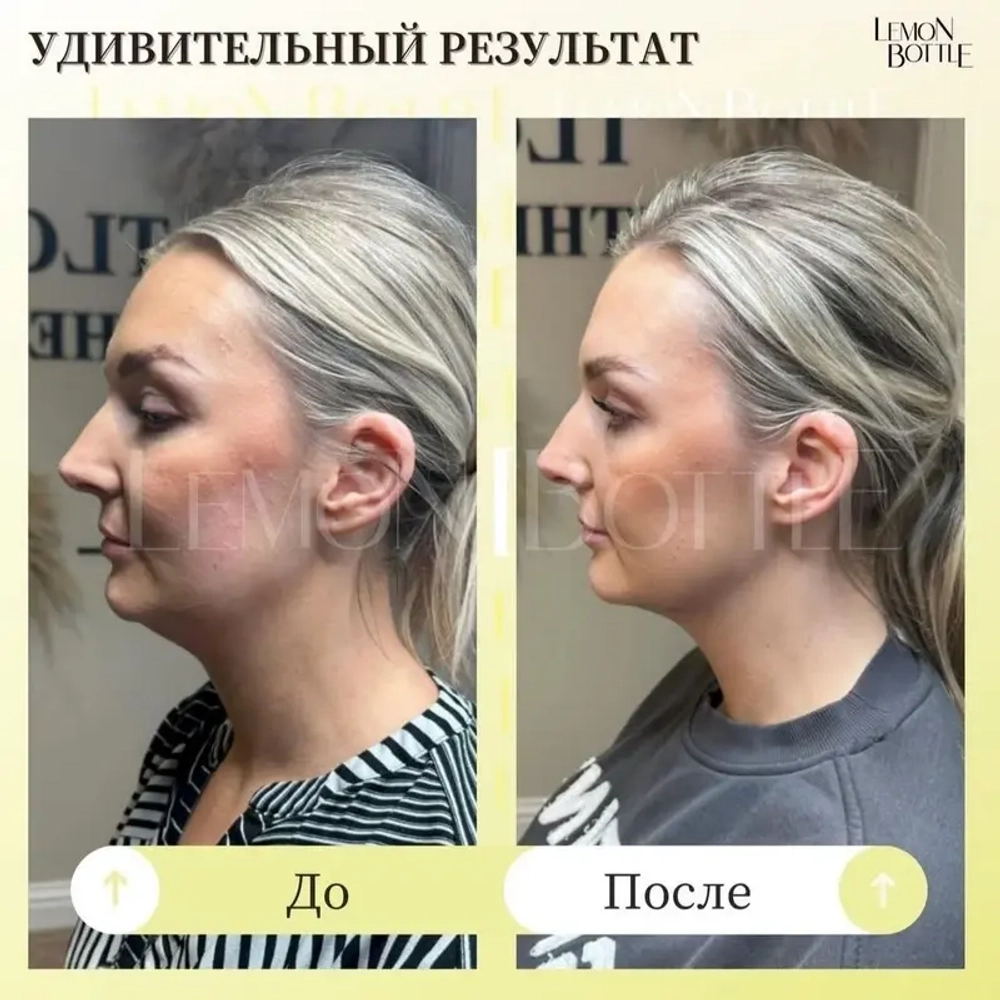 LemonBottle Ampule Solution | Липолитик непрямой