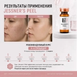 Jessner’s Peel AGT Р