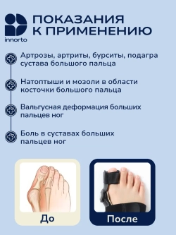 Вальгусная шина от косточки (шарнирная), 2 шт