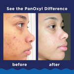 PanOxyl, очищающая пенка от акне, для лица и тела, максимальная эффективность, 85 г (3 унции)