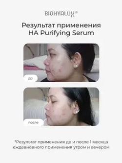 Сыворотка матирующая для проблемной и жирной кожи | BIOHYALUX НА PURIFYING SERUM 30х1,5 мл