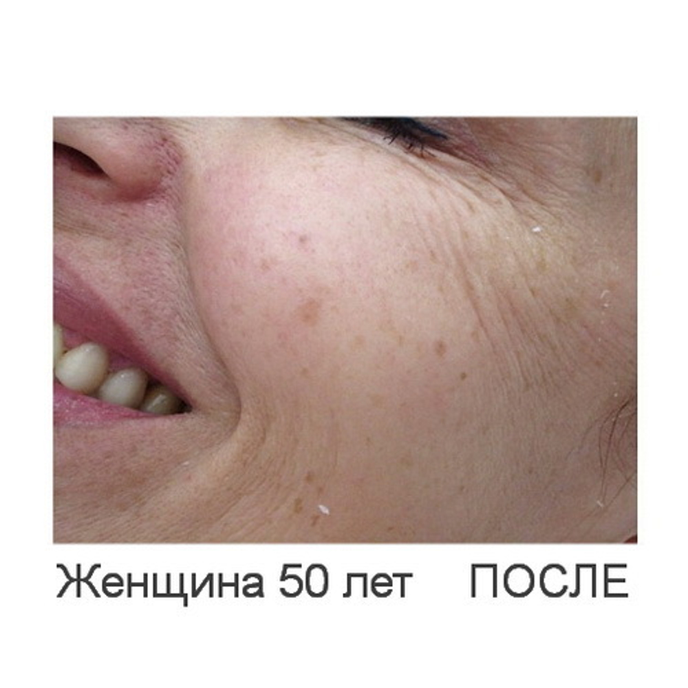 Skin-R | Реструктуризация | ГК+Аминокислоты