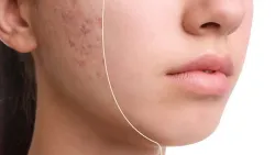 Веганский пилинг-тоник с 7% гликолевой кислоты The Ordinary Glycolic Acid 7% Exfoliating Toner 240 мл.