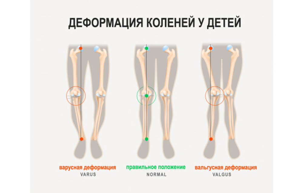 Детский функциональный ортез колена с крестообразными ремнями Reh4Mat