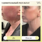 LemonBottle Ampule Solution | Липолитик непрямой