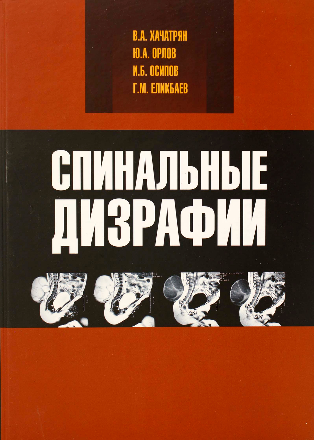 Спинальные дизрафии: нейрохирургические и нейроурологические аспекты