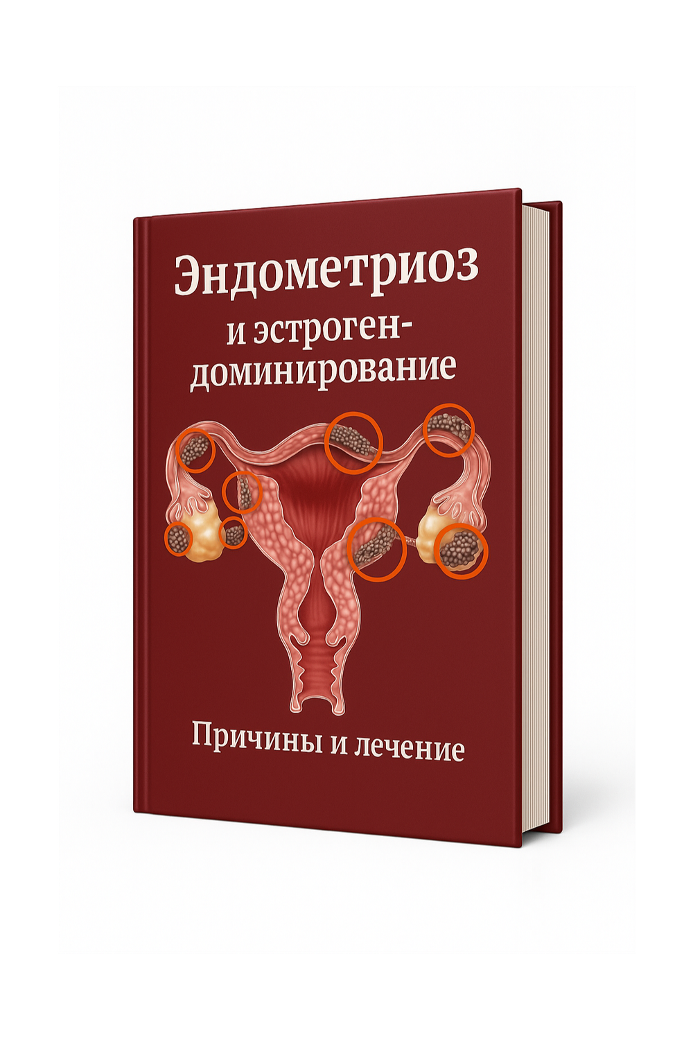 Эндометриоз и эстрогендоминирование Причины и лечение (электронный формат)