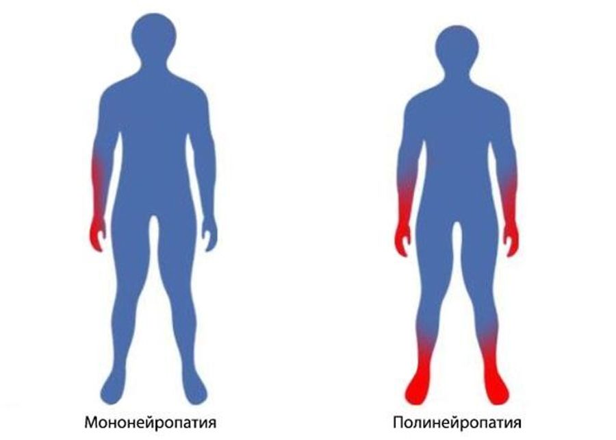 Полинейропатия - что это такое? Полинейропатия - что это такое?