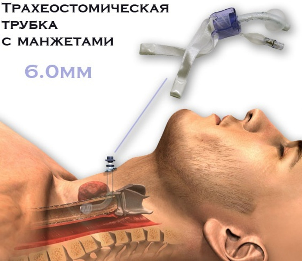 Трахеостомическая трубка с манжетами, 6.0мм