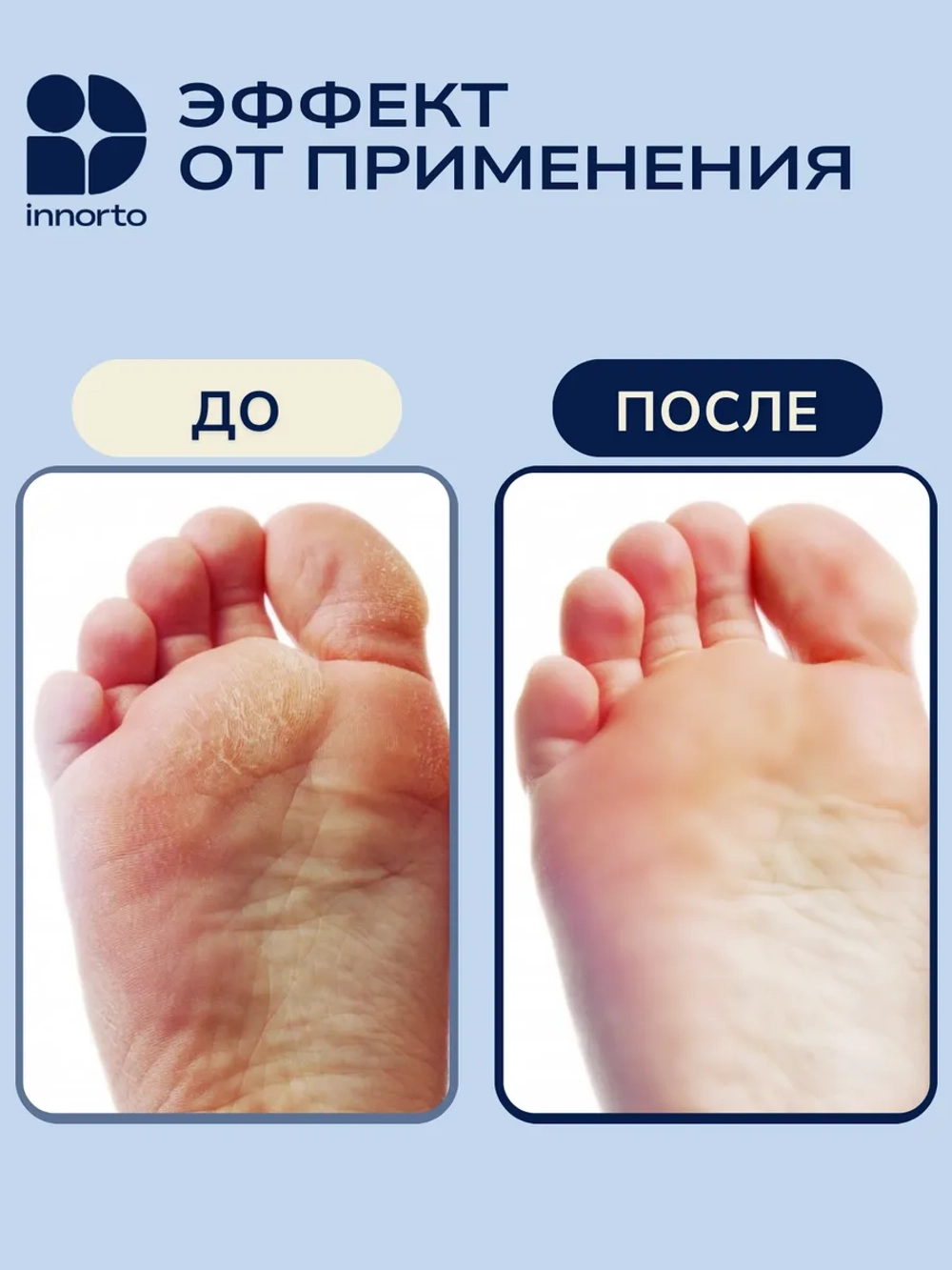 Увлажняющие носочки для ног, межпальцевые разделители 21238