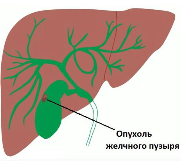 Нима сабабдан сафро тўпланиб қолади? Нима сабабдан сафро тўпланиб қолади?