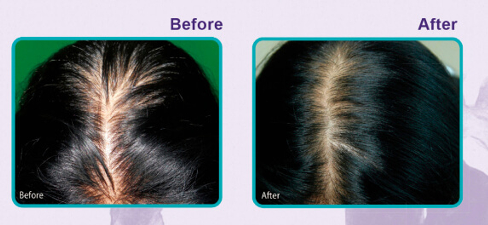 Daeng Gi Meo Ri Эмульсия против выпадения волос Vitalizing Scalp Pack for Hair-loss Vitalizing, 145МЛ Scalp Pack for Hair-loss