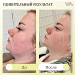 LemonBottle Ampule Solution | Липолитик непрямой