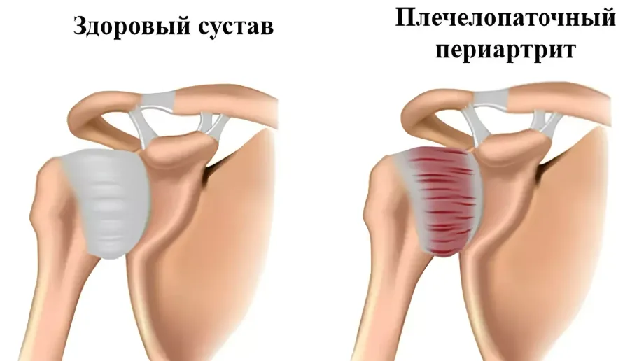 Что такое плечелопаточный периартрит? Что такое плечелопаточный периартрит?