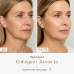 Collagen+ Akvavita | Рекомбинантный коллаген III типа